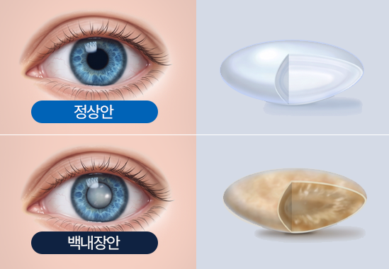 정상 수정체 vs 혼탁한 백내장 수정체 비교
