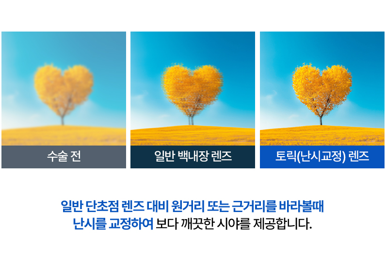 난시교정 설명 이미지