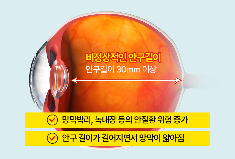 근시 억제 치료의 중요성