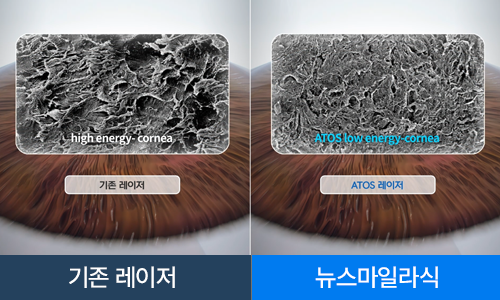 낮은 에너지 레이저 조사