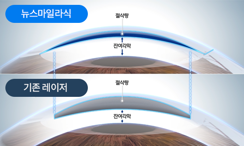 아치형 사이드컷 잔여각막 확보