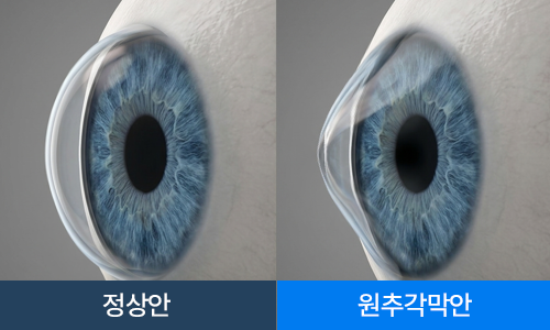 원추각막 예방