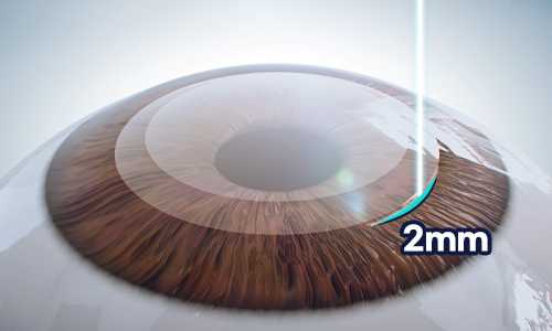 2mm 미세 절개창 생성