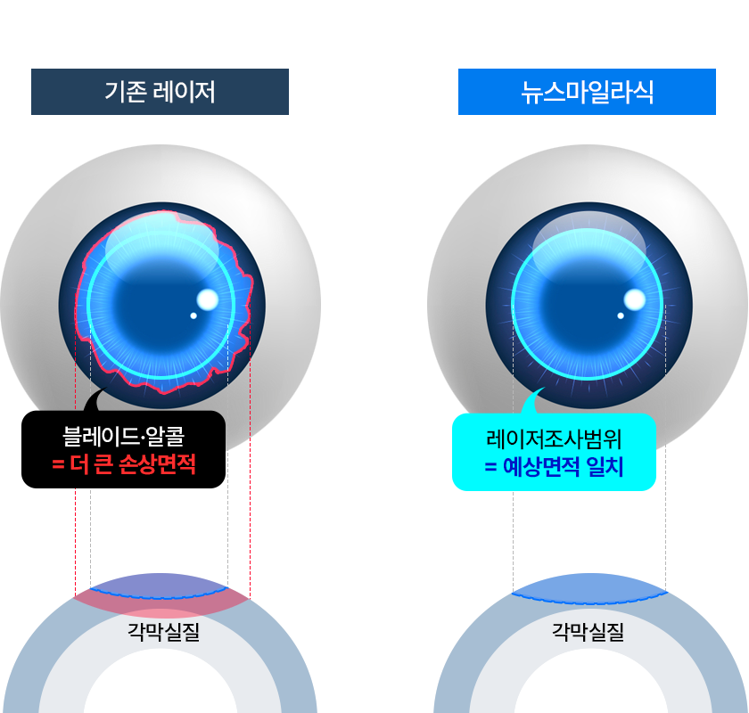 기존 라섹 vs 투데이라섹 상처면적 비교