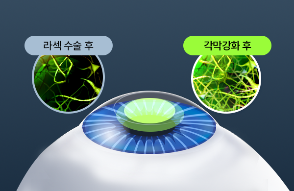 엑스트라 각막강화술